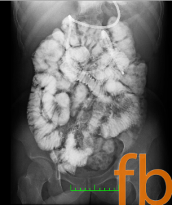Fatboy Has Intestines