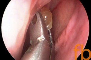 New Sinus Polyp